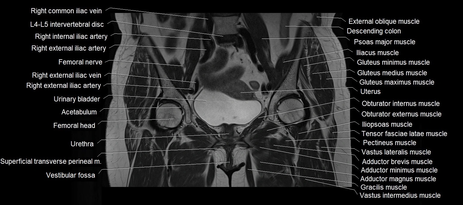 MRI 3T pelvis coronal cross section anatomy image 11.webp